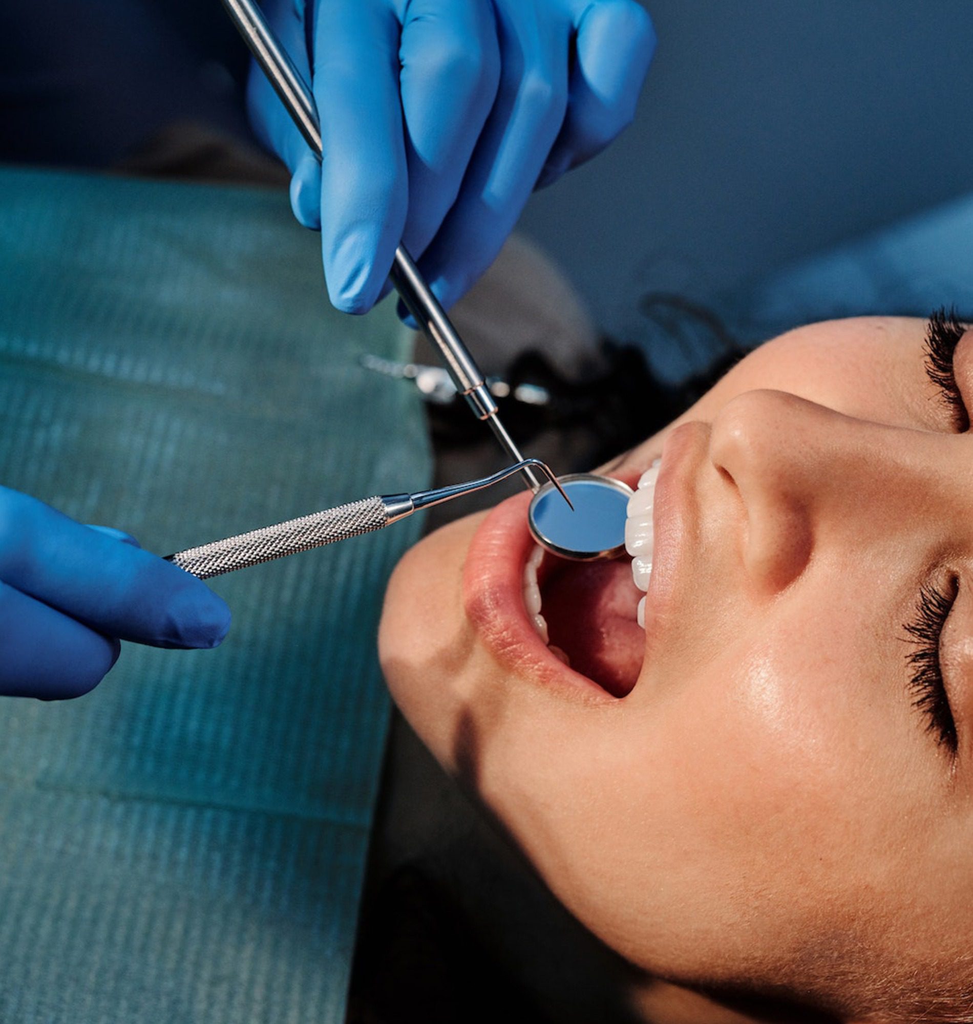 Veneers