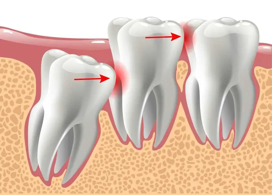 Wisdom Teeth Removal