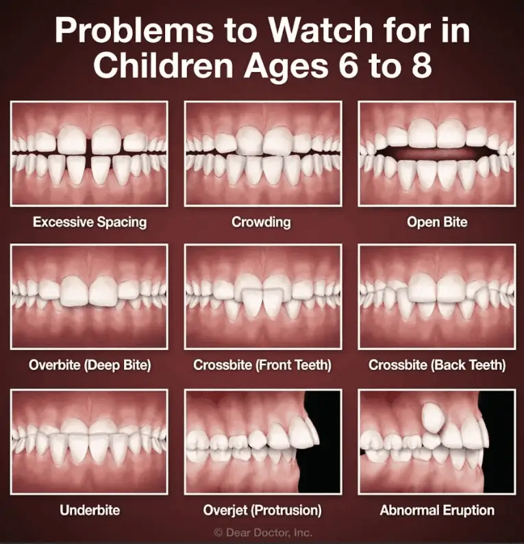 Problems to watch in children having Misaligned teeth