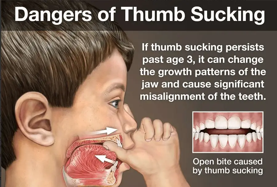 Dangers of Thumb Sucking