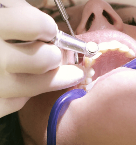 Dental Fillings