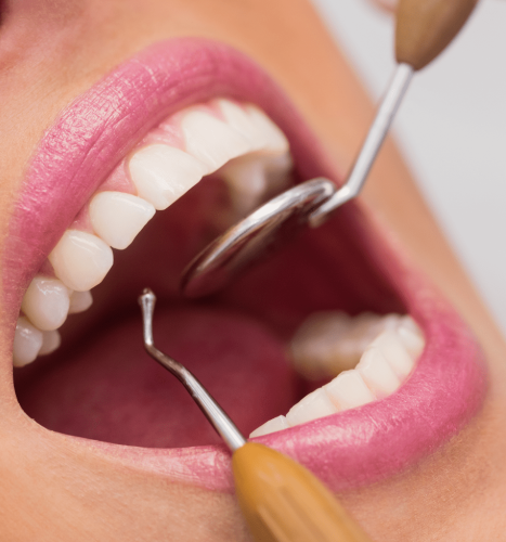 Repairing Broken or Damaged Teeth