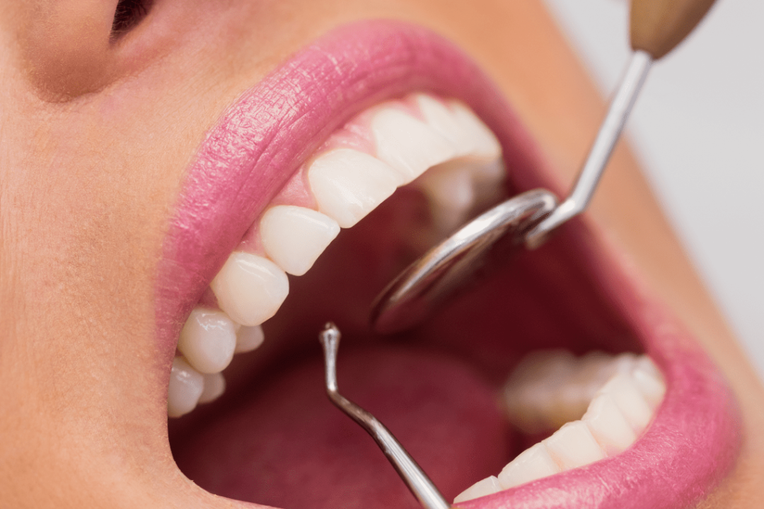 Dental-cleaning-deep