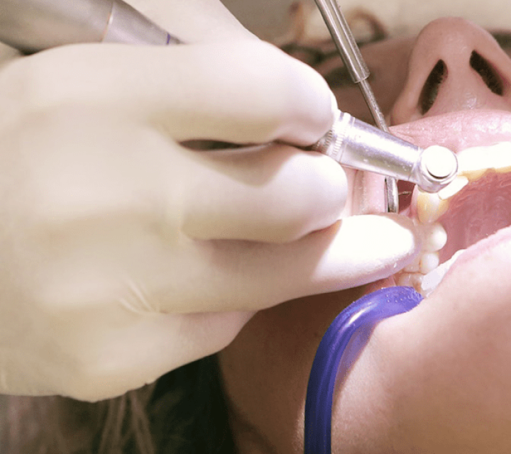 Dental Fillings at My Tamarac Dentist