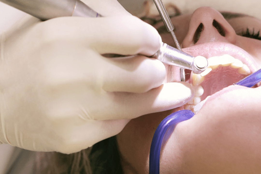 Dental Fillings at My Tamarac Dentist